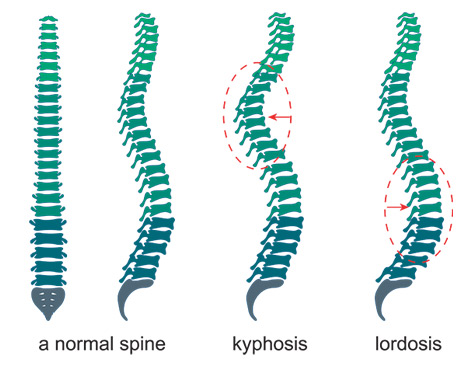 the difference between a normal spine, kyphosis and lordosis